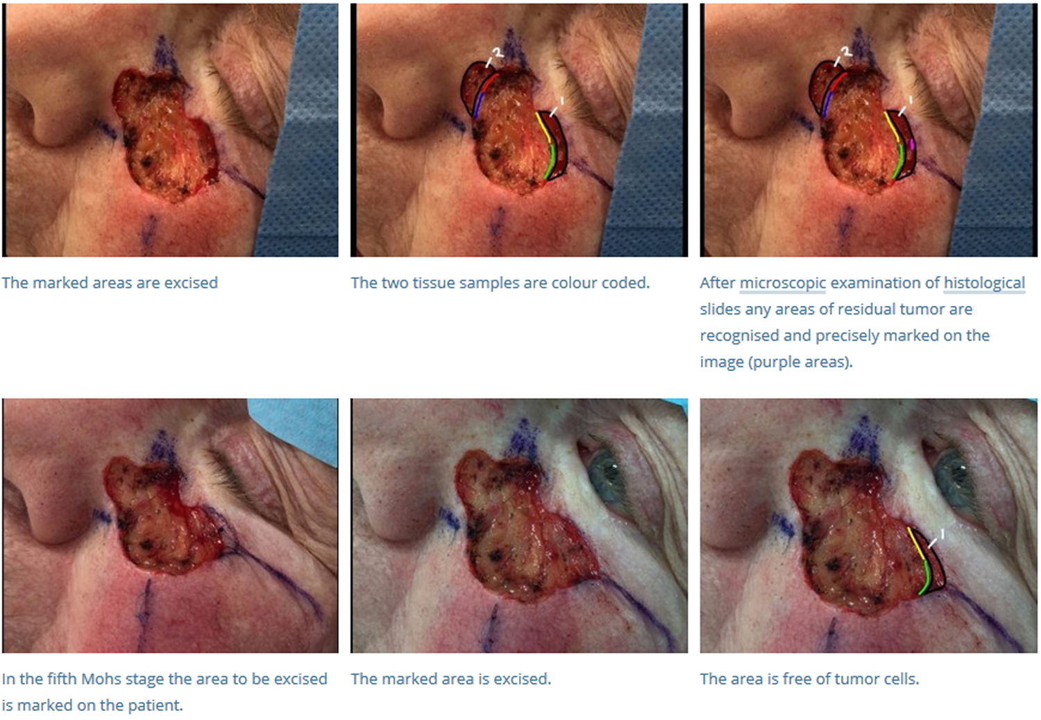 Mohs surgery for infiltrative basal cell carcinoma
