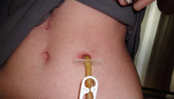 PEG tube