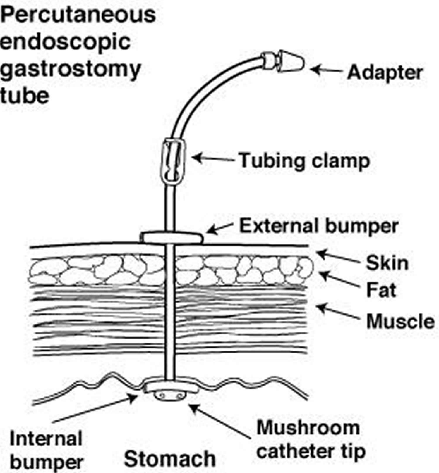 PEG Tube - Placement, Removal, Replacement, Complications