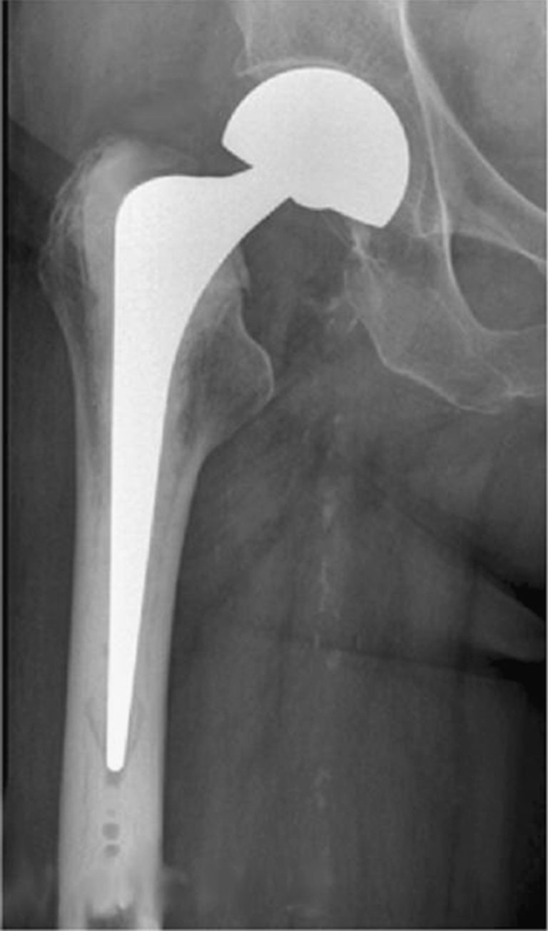 Hip Replacement Surgery Recovery Time, Alternatives, Risks