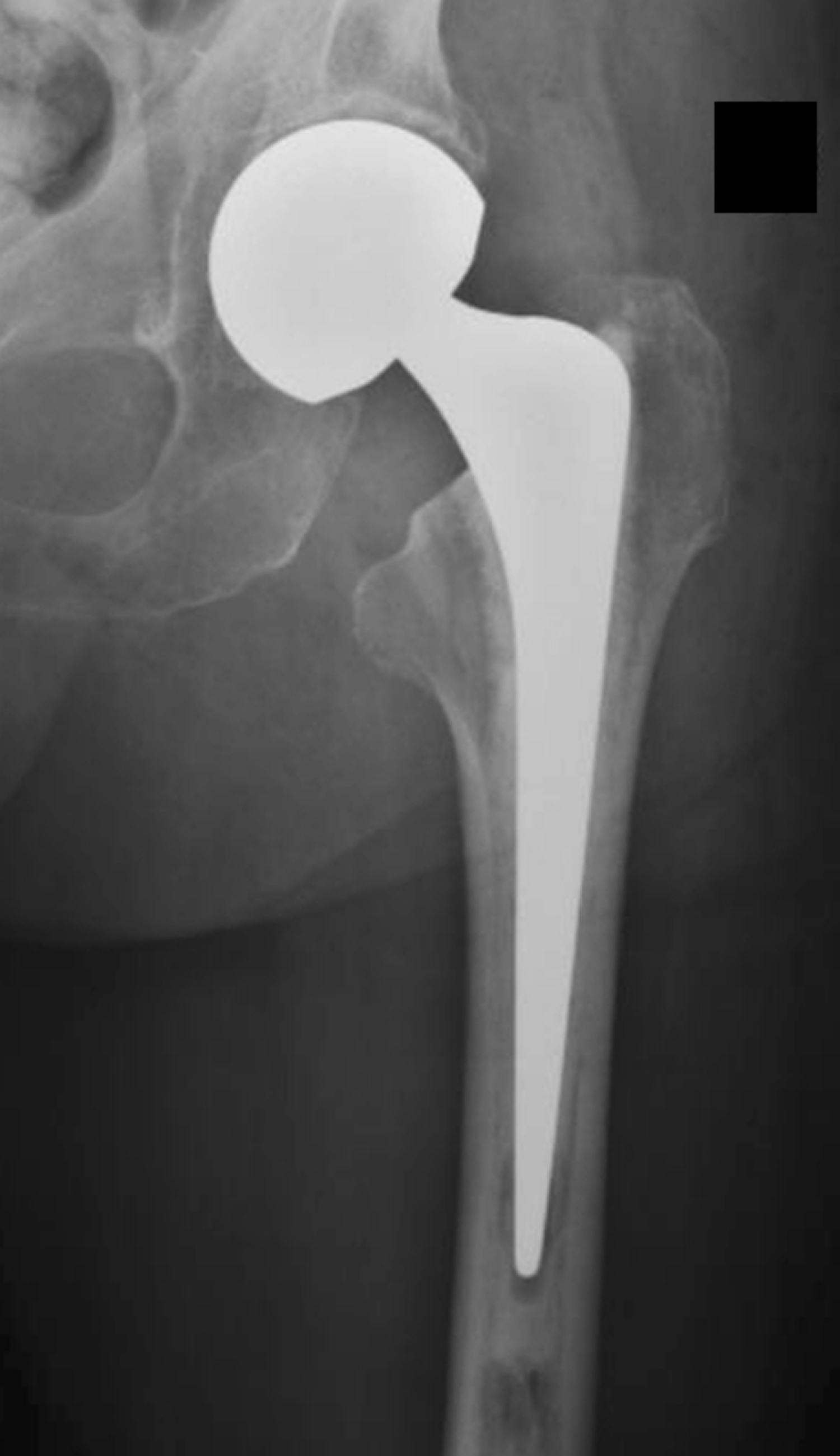 Partial hip replacement