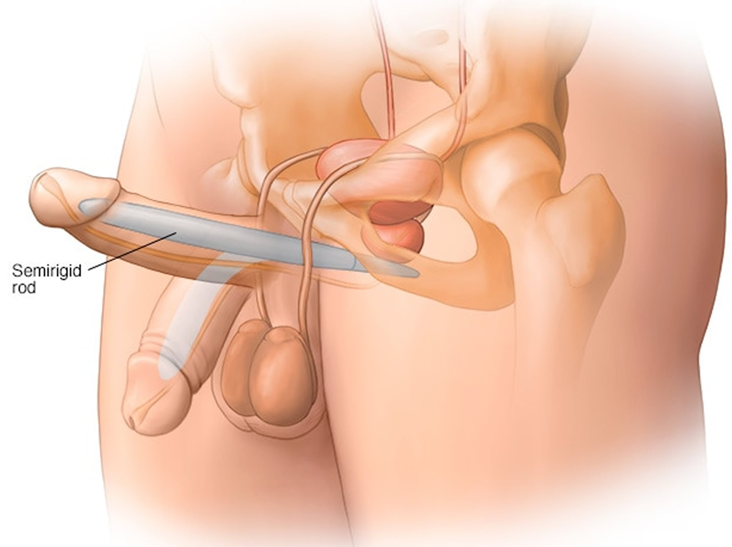 Penile implant semi-rigid
