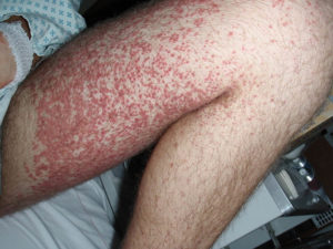 platelet disorders pinpoint rash