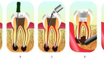 root canal procedure