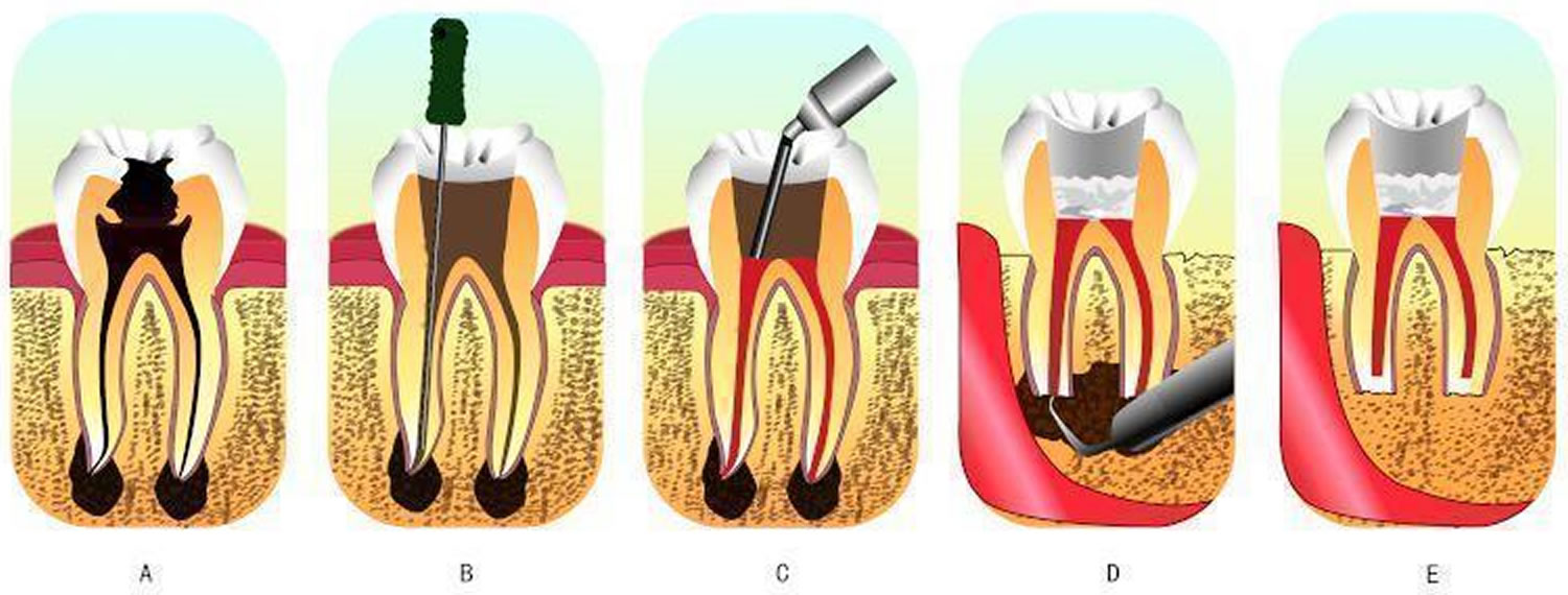 Evo root canal