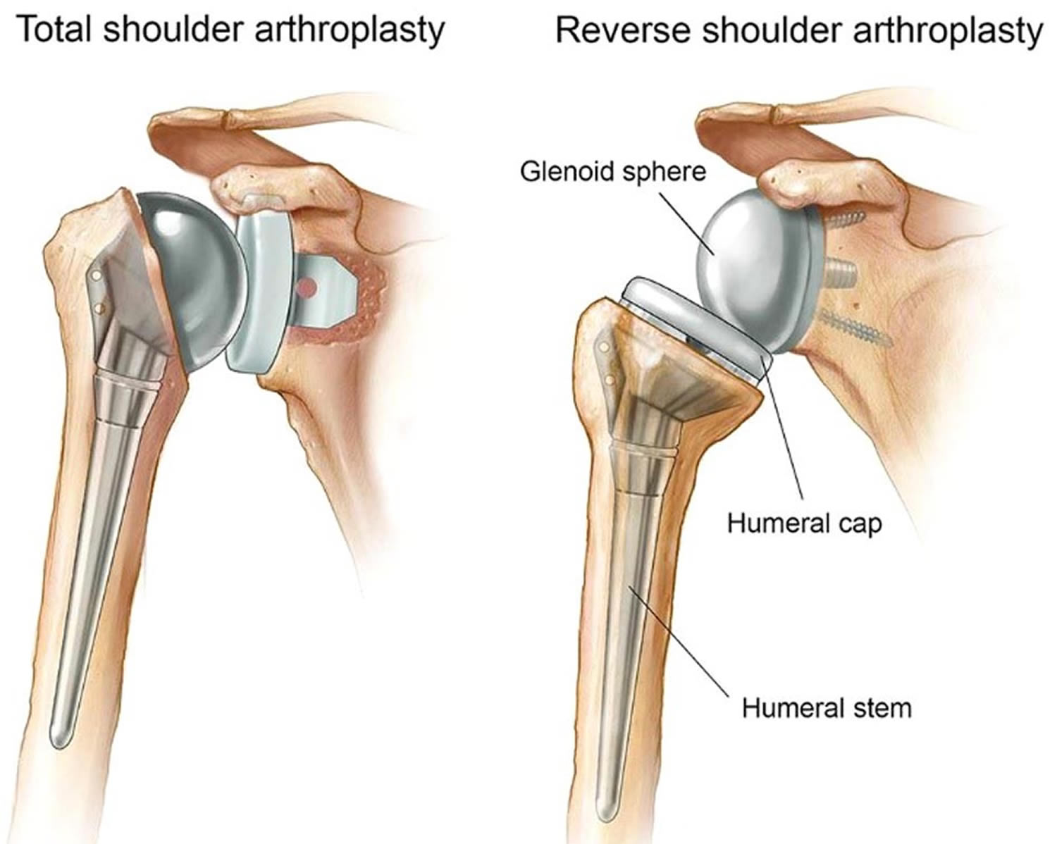 Shoulder arthroplasty