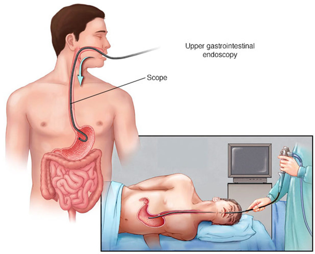 after effects of upper endoscopy