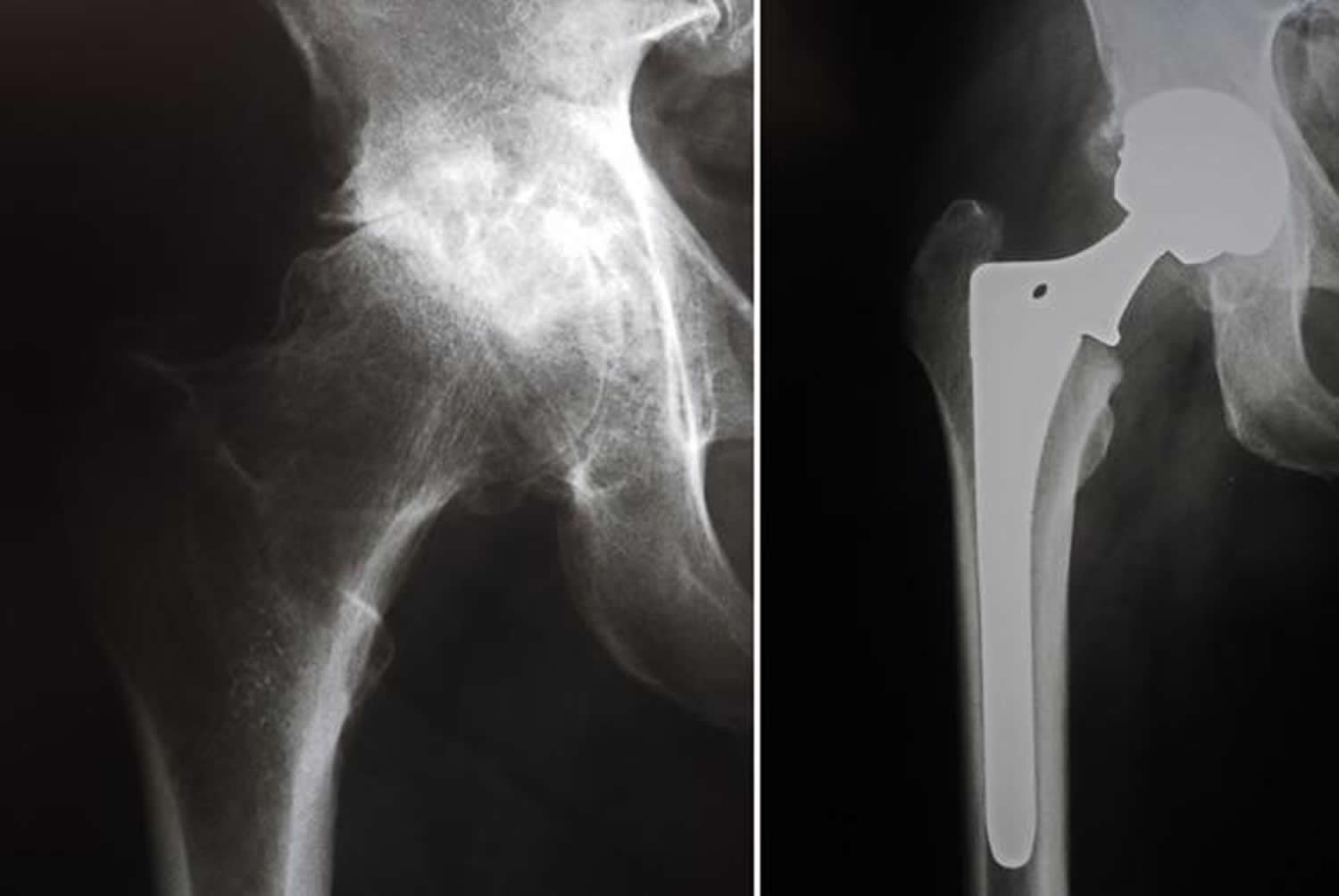 xray of normal hip replacement