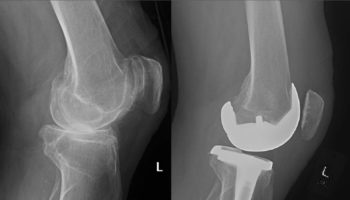 arthroplasty