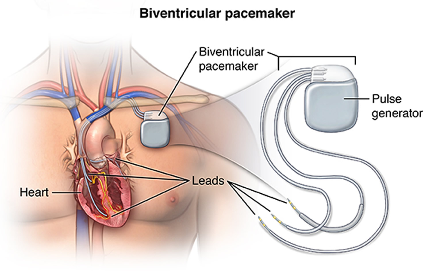 Pacemaker Heart Pacemaker Indications How A Pacemaker Work 