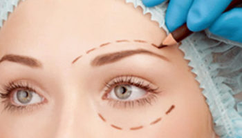 blepharoplasty