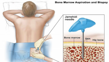 bone_marrow_biopsy