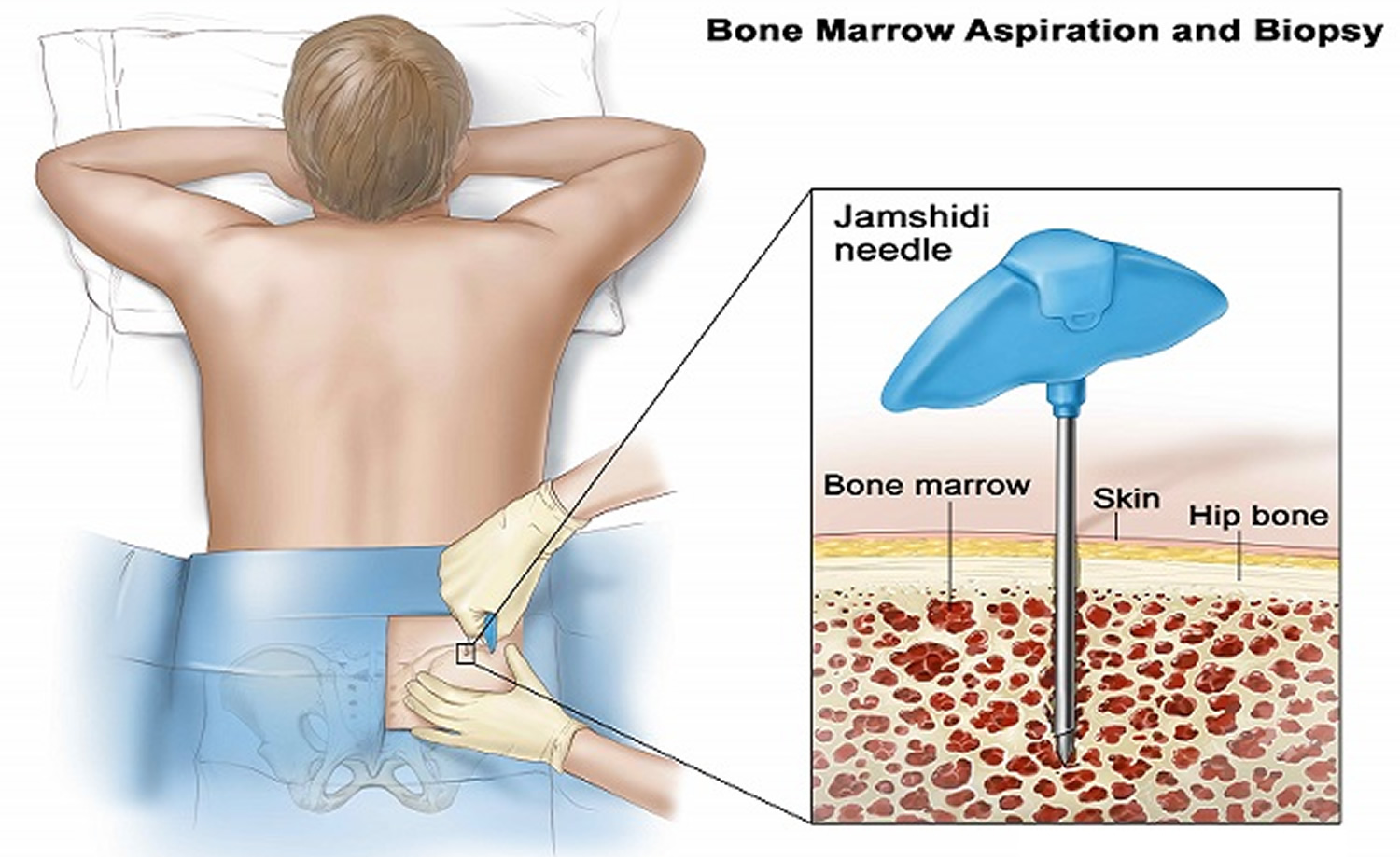 Reasons You Can T Donate Bone Marrow