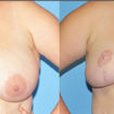 breast reduction