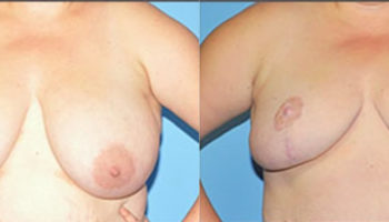 breast reduction