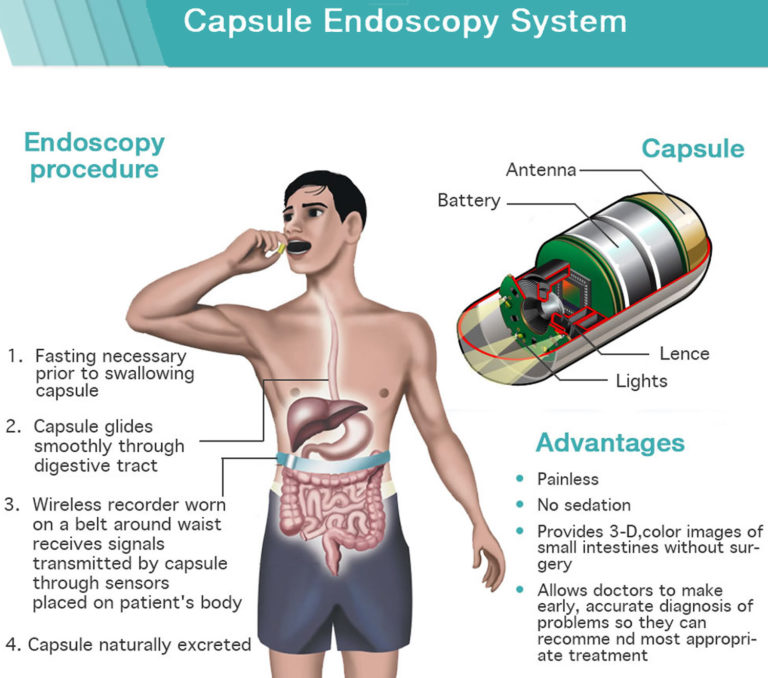 Endoscopy - Prep, Risks and Endoscopy Procedure