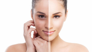 chemical peel