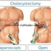 cholecystectomy