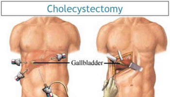 cholecystectomy