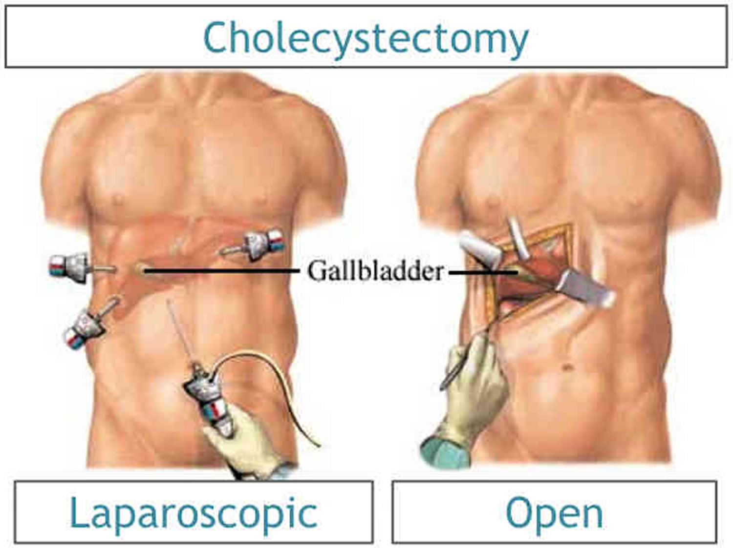 my-swollen-belly-after-gallbladder-surgery-after-gallbladder-surgery