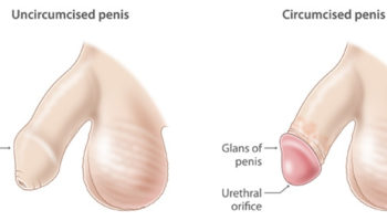 circumcision