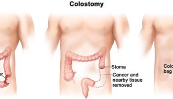 colostomy