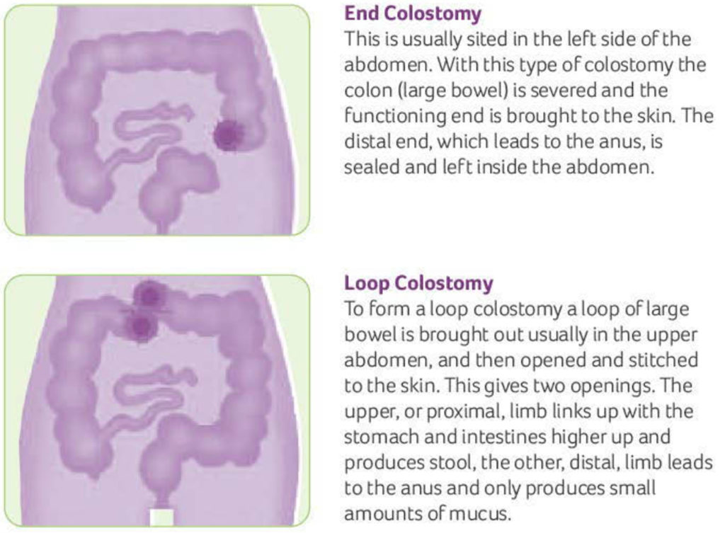 Colostomy - How To Change A Colostomy Bag & Living With It