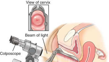 colposcopy