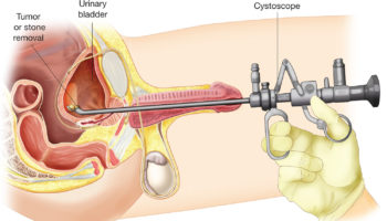 cystoscopy