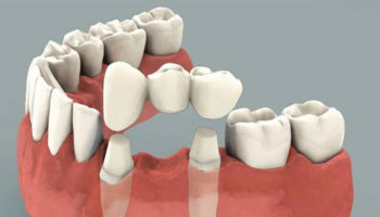 dental bridge