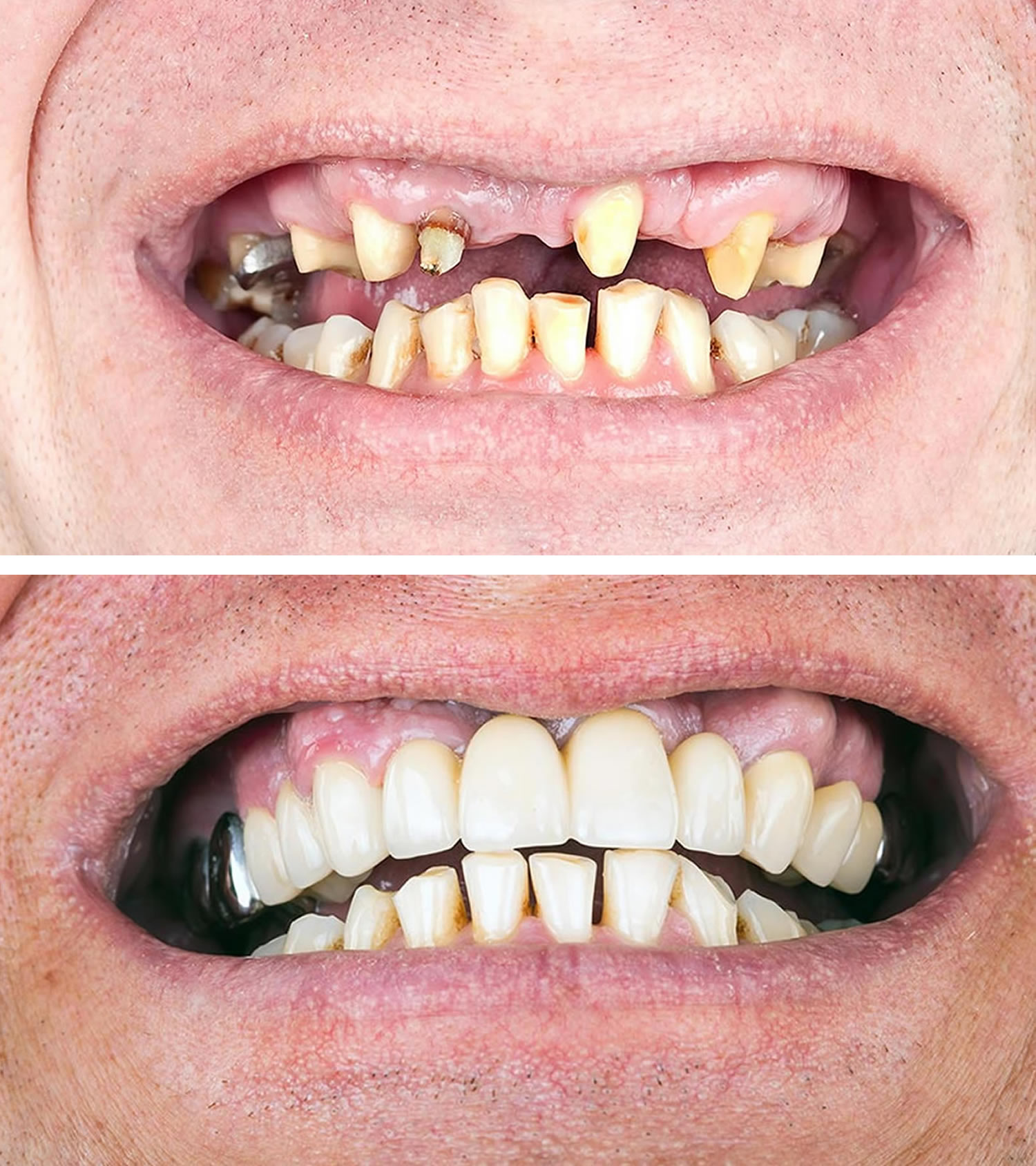 how-long-does-a-tooth-bridge-last-how-long-does-a-dental-bridge-last