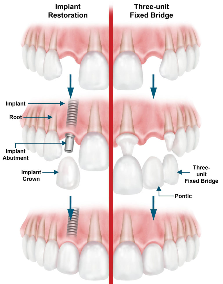 Dental Bridge Procedure, Dental Bridge Vs Dental Implant