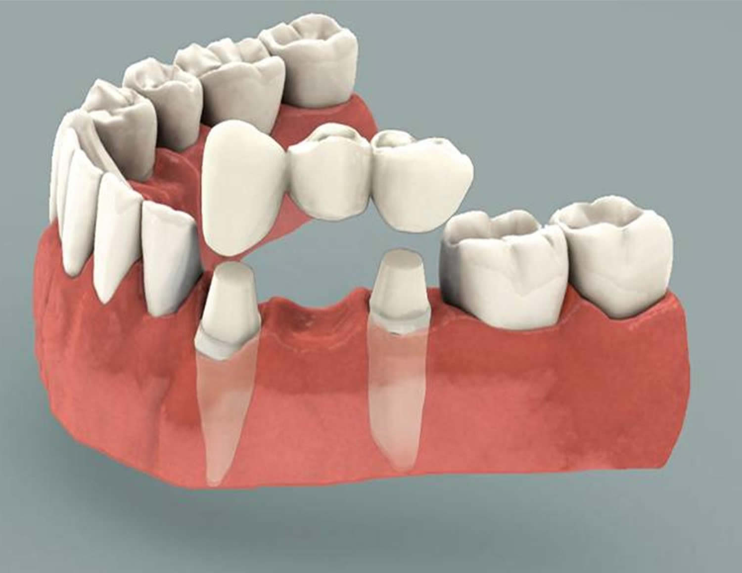 dental-bridge-procedure-dental-bridge-vs-dental-implant