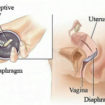 diaphragm_birth_control