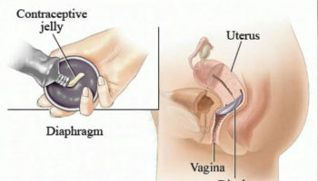 diaphragm_birth_control