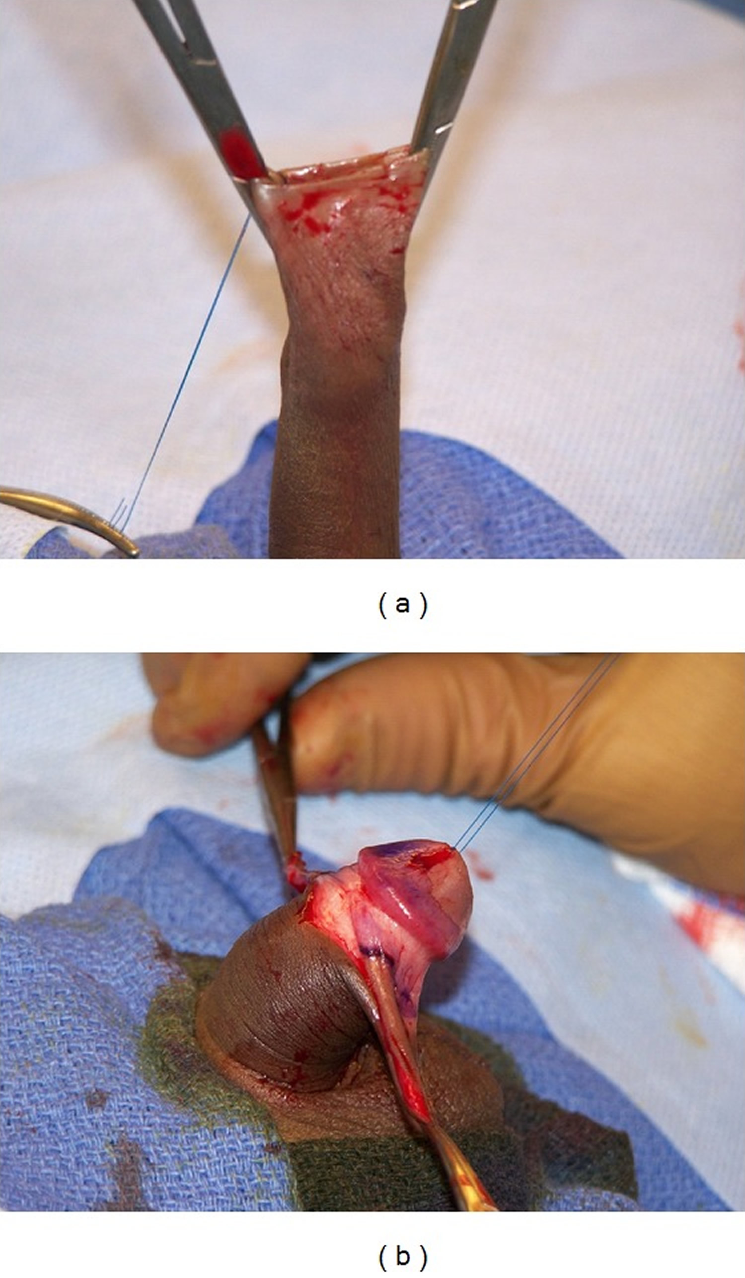 Newborn Circumcision: The Gomco Method | Consultant360