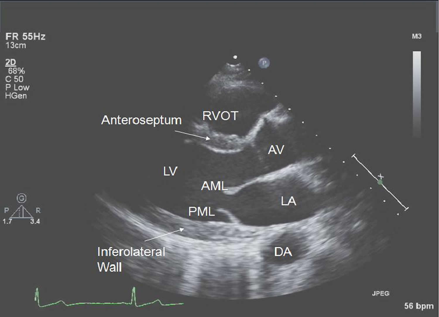 Echocardiogram, Transesophageal, Transthoracic, Stress Echocardiogram