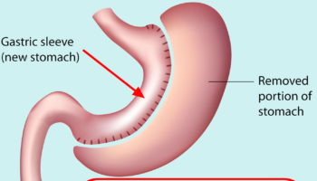 gastric sleeve surgery