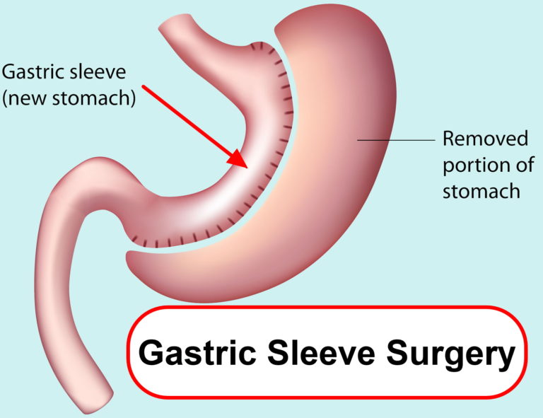 Gastric Sleeve Reviews, Surgery Complications, Recovery Time and Diet