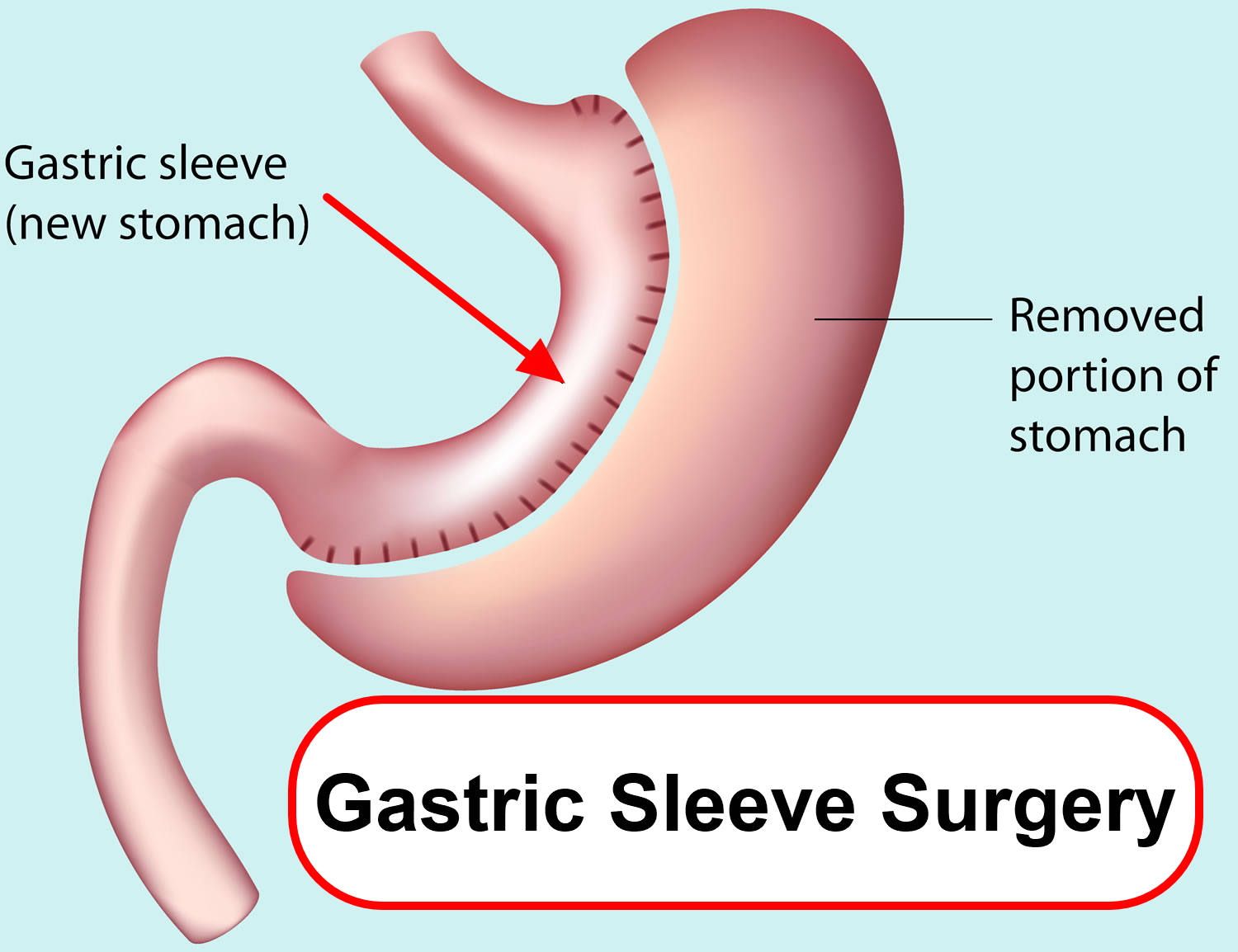 bmi calculator for gastric sleeve