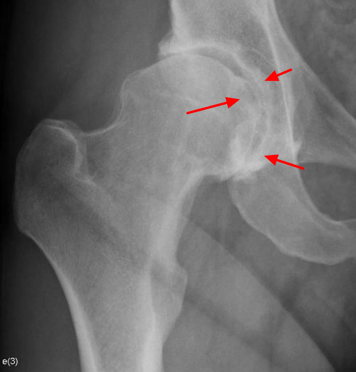 normal hip xray compared to oa