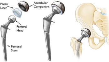 hip replacement