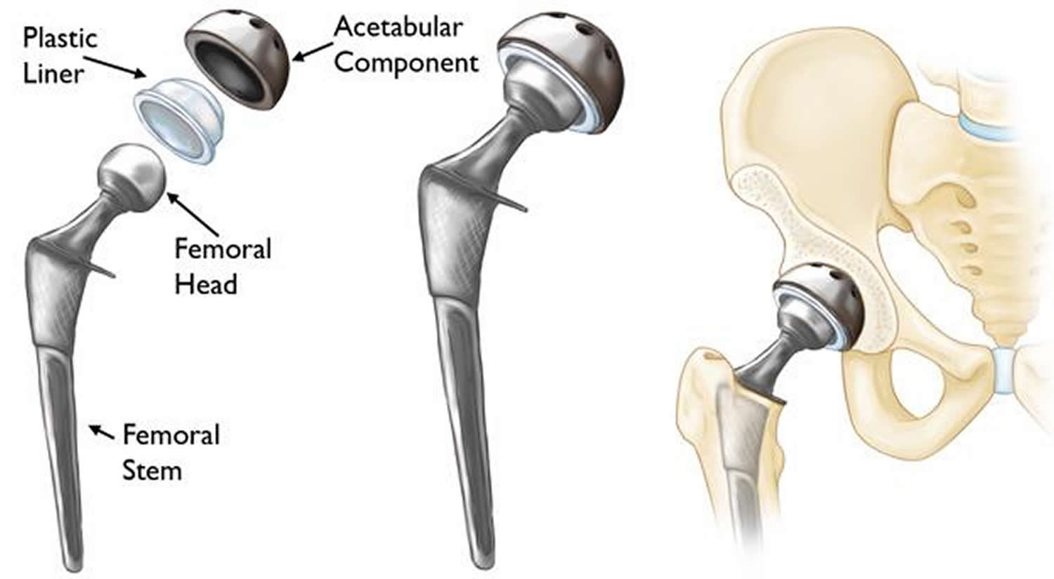 How Long Is Recovery After Hip Replacement