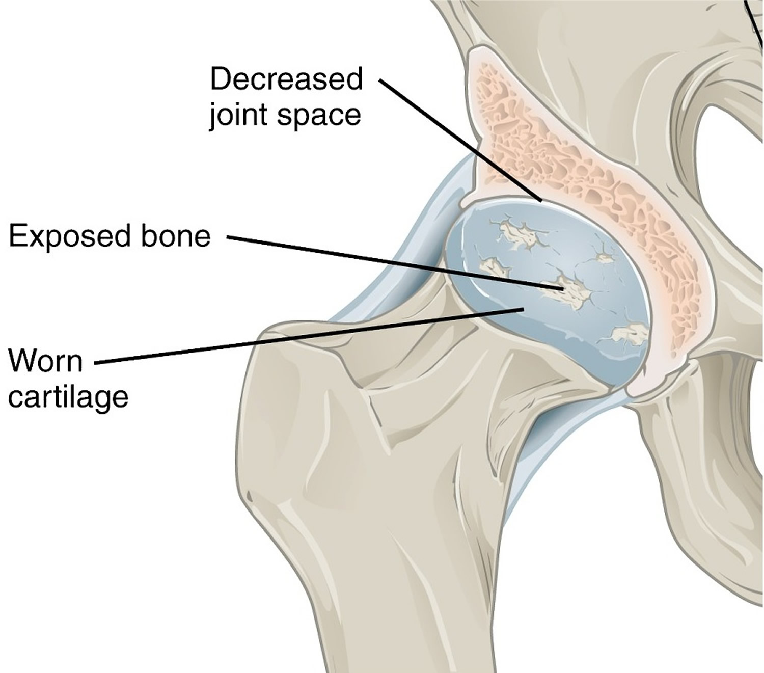 hip osteoarthritis