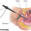 hysteroscopy