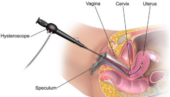 hysteroscopy