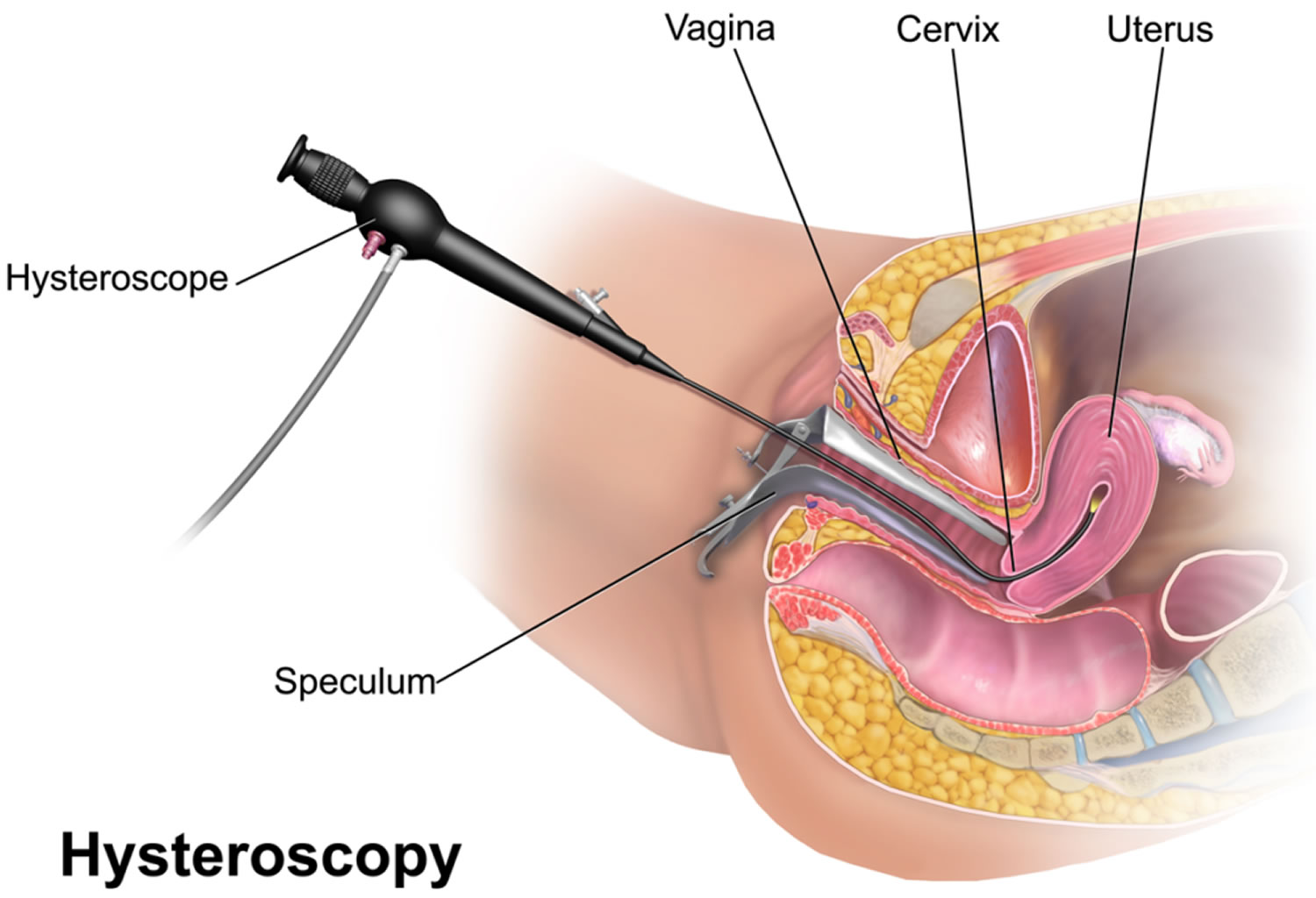 Passing clots/tissue after D&C (pic) - Miscarriage Support