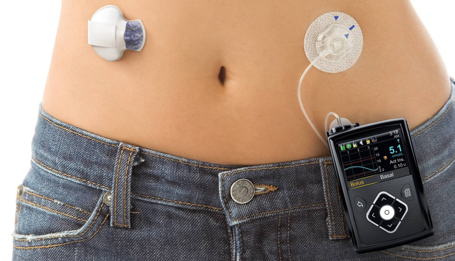 Diabetes Insulin Pump - How Insulin Pump Work, Pros & Cons