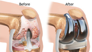 knee replacement