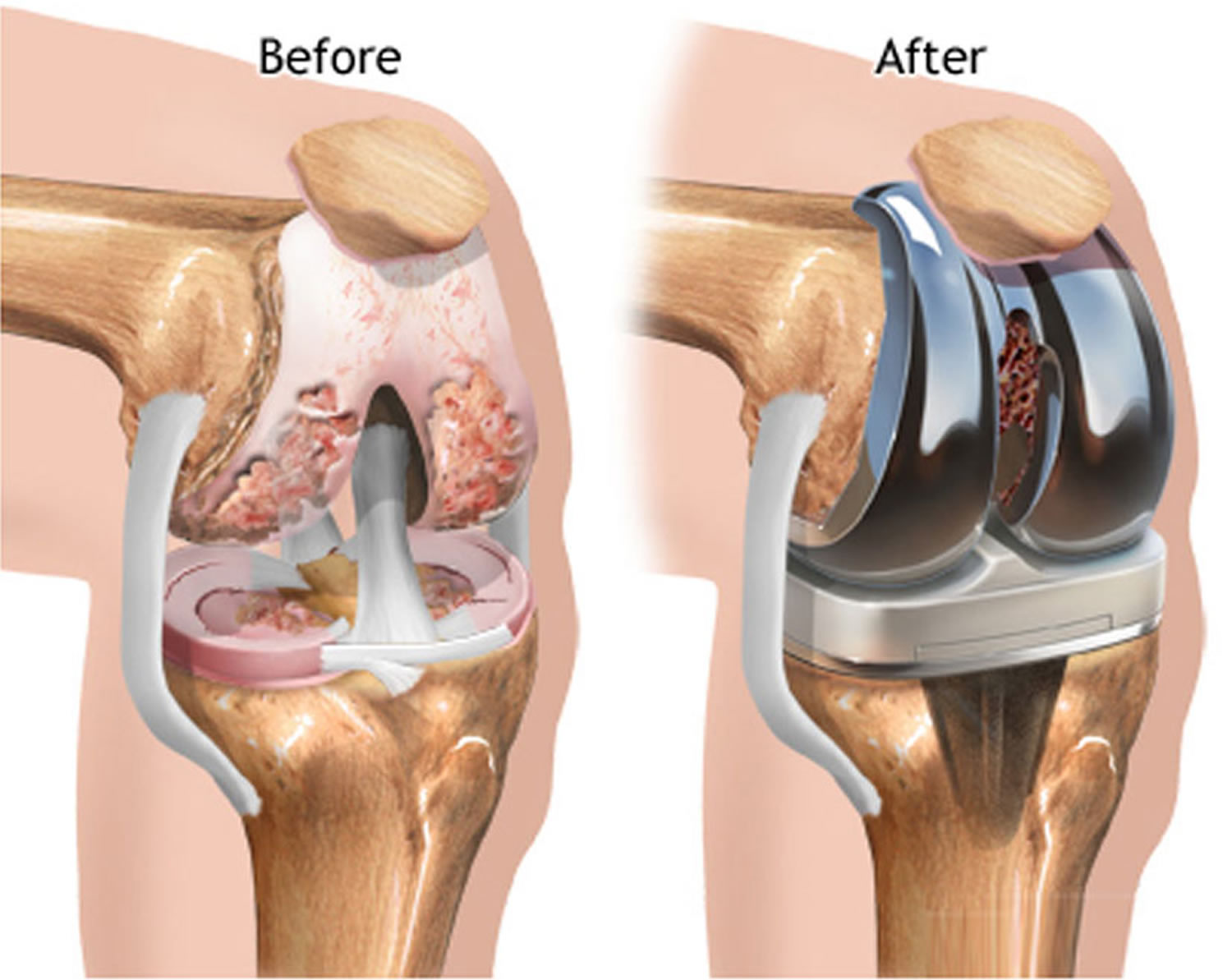 Knee Replacement Surgery, Recovery Time, Complications